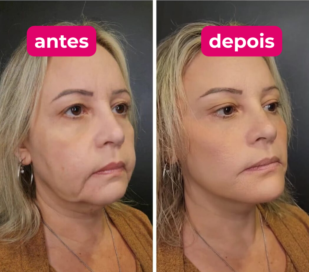 Antes e depois do tratamento facial 1