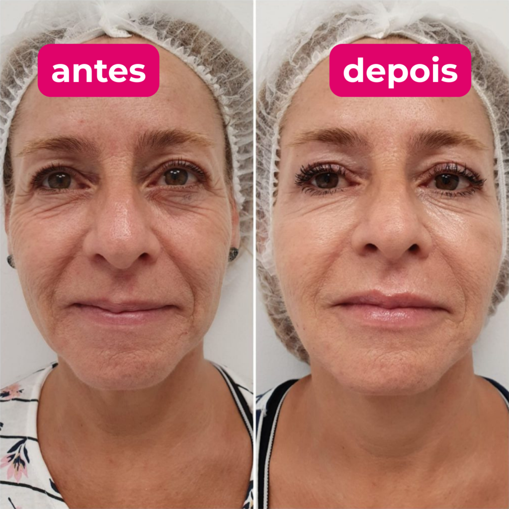 Antes e depois do tratamento facial 2