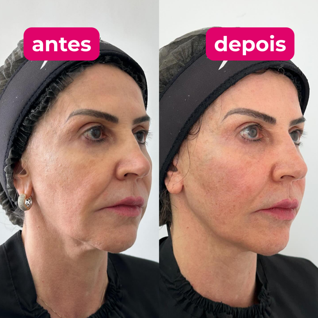 Antes e depois do tratamento facial 3